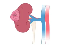 Nephrectomy in Turkey